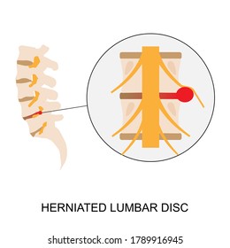 Illustration demonstration of human herniated lumbar disc. Lumbar disc herniation can cause low back pain and sciatica