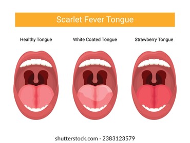 Illustration of dengue fever tongue stage