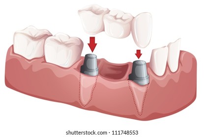 Illustration Of A Dental Bridge