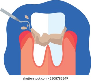 Ilustración del tratamiento del cálculo dental