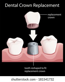 Illustration of a dental crown replacement