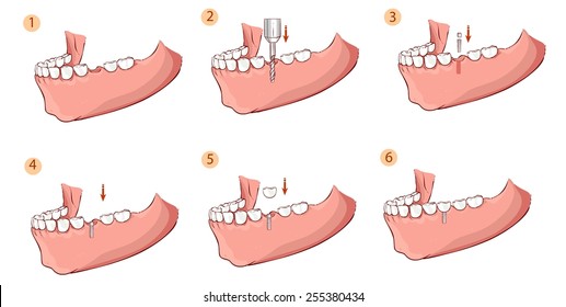 Illustration of a dental implant