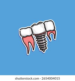 Ilustração de implante dentário com parafusos de fixação e dentes gráfico no fundo azul