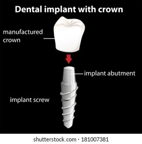 Illustration of a dental implant with crown