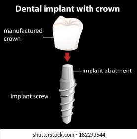 Illustration of a dental implant with crown