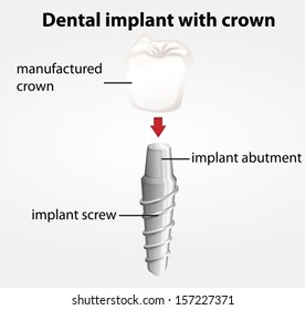 Illustration of a dental implant with crown on a white background