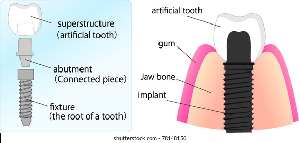 Illustration Of Dental Implant And Its Elements