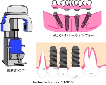 illustration of dental implant and its elements, dental CT