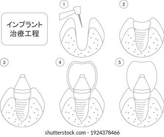 Illustration of dental implant treatment process.
The meaning of the letters is the treatment process of the implant.