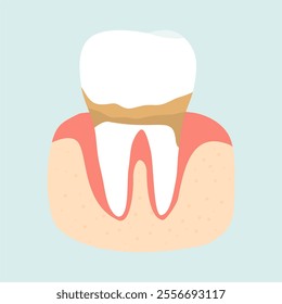 Illustration of Dental Plaque Teeth 