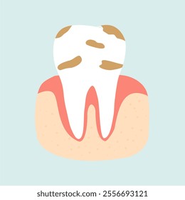 Illustration of Dental Plaque Teeth 