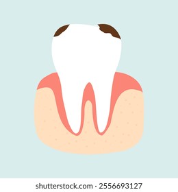 Illustration of Dental Plaque Teeth 