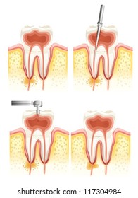 Illustration of a Dental root canal deterioration on a white background