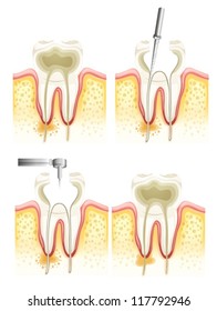 Illustration of the dental root canal process