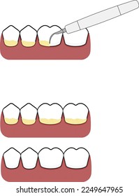 una ilustración de la escala y limpieza dentales eliminando tartar o placa utilizando escalador ultrasónico