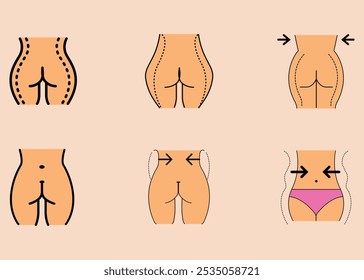 An illustration depicting different stages of butt lift surgery, showcasing before and after results with dotted lines indicating the surgery areas.