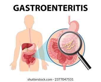 Illustration depicting gastroenteritis, its causes, and associated symptoms