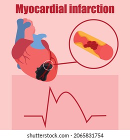 Ilustración que representa un ataque al corazón. Necrosis miocárdica. Cambios en el ECG con un ataque cardíaco. Trombosis de la arteria coronaria.