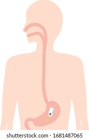 Illustration Depicting An Inspection With A Gastroscope(capsule Endoscope)