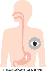 Illustration Depicting An Inspection With A Gastroscope(capsule Endoscope)