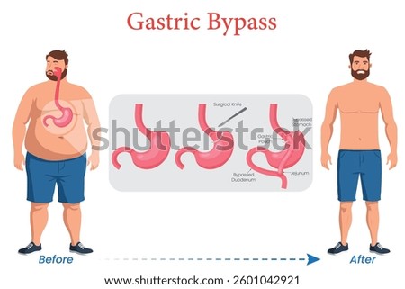 An illustration depicting a man before and after gastric bypass surgery, highlighting weight loss and body transformation.