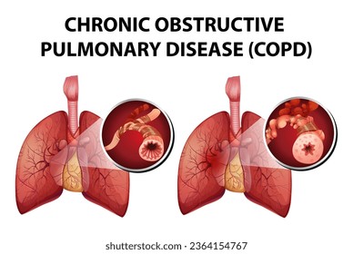 Illustration, die die medizinischen Aspekte einer chronisch obstruktiven Lungenerkrankung abbildet
