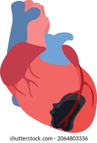 Illustration Depicting Myocardial Infarction As A Result Of The Formation Of Coronary Artery Thrombosis. Acute Coronary Syndrome. Heart Disaster. Myocradial Muscle Necrosis. Emergency Cardiology.