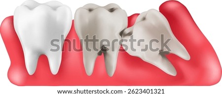 Illustration depicting a partially impacted wisdom tooth The image shows three molars, with the rearmost tooth positioned horizontally and pressing against 