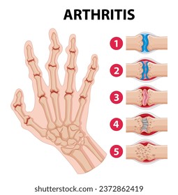 Illustration depicting the stages of arthritis in a human hand