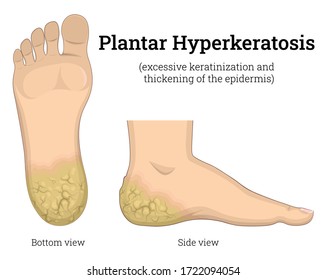 Illustration of dermatological diseases Plantar Hyperkeratosis