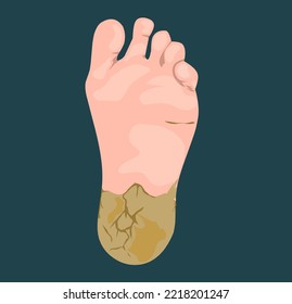 Illustration of dermatological diseases Plantar Hyperkeratosis