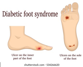 Illustration of diabetic foot syndrome. Shown ulcers on the inside and plantar of the foot.