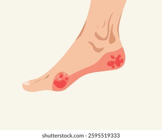 illustration of a diabetic foot with ulcers and infection. Medical concept depicting complications of diabetes, neuropathy, and poor circulation in the feet.