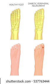 Illustration of Diabetic Peripheral Neuropathy. Healthy foot and foot with damaged nerves and ulcers on the toes. Used: transparency, gradient, blend mode.