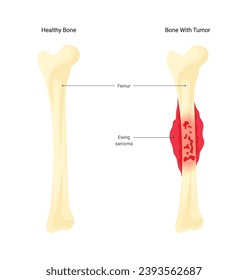 Illustration Diagram of Bone Cancer Disease