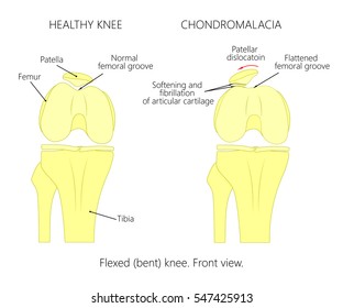 Illustration (diagram) of normal knee joint and a knee with chondromalacia patella. Flexed (bent) knee. Front view.