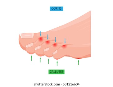 Illustration of difference between Corns and calluses. Used: gradient, transparency