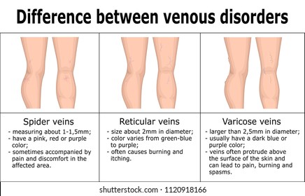 Illustration of difference between venous disorders, such as spider veins, reticular veins and varicose veins.