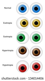  Illustration Of Different Eye Disorders. Gaze disorders or ocular misalignment disorders (strabismus) include: esotropia, exotropia, hypertropia and hypotropia.