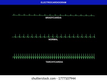 Illustration der unterschiedlichen Herzfrequenz im Elektrokardiogramm. Langsame oder Bradykinese, normale und schnelle oder Tachykardie Heratrate.