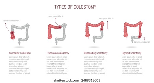 Illustration of different types of colostomy: ascending, transverse, descending, and sigmoid.