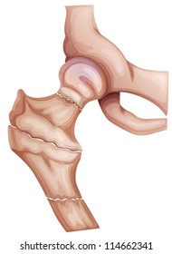 Illustration Of Different Types Of Hip Fractures