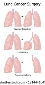 Illustration of different types of lung cancer surgery
