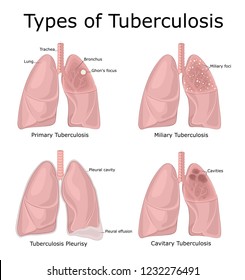 Illustration of different types of tuberculosis - primary, miliary, cavitary, pleurisy
