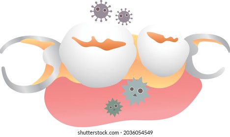 The illustration of dirty partial Denture
