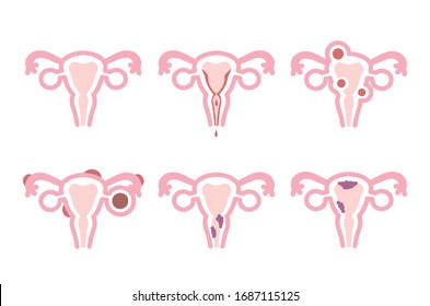 Illustration of the disease that occurs in the human uterus