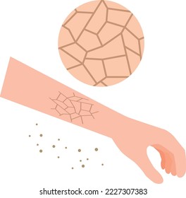 Illustration of dry and cracked skin