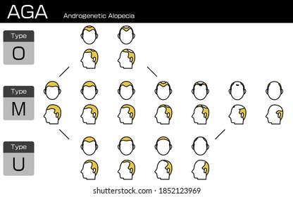 Illustration of each type of AGA androgenetic alopecia and progress stage