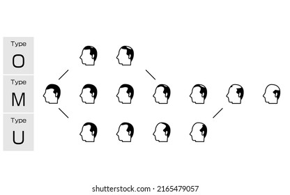 Illustration of each type of AGA androgenetic alopecia and progress stage