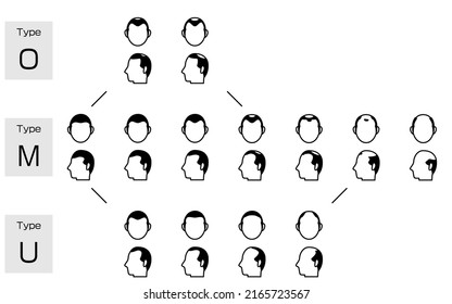 Illustration of each type of AGA androgenetic alopecia and progress stage